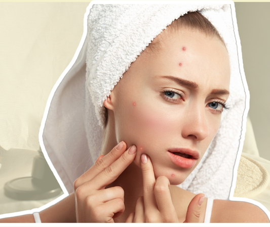 Piel con tendencia al acné: cómo crear una rutina sencilla